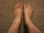 Sprained Ankle