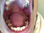 Teeth Rot